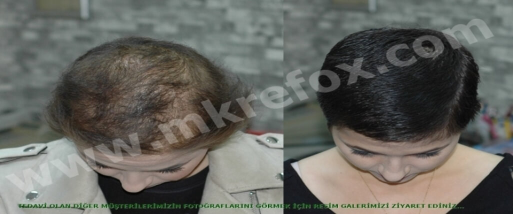 Alopesi Areata için İyileşme