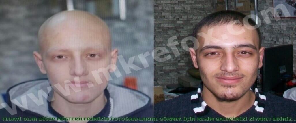 Alopesi Areata ve Saç Dökülmesi