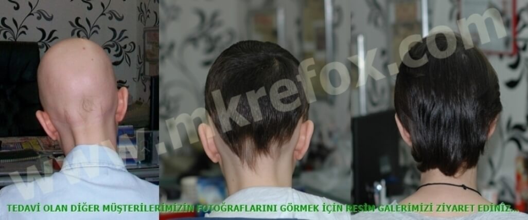 Alopesi Tedavisinde Etkin Çözümler