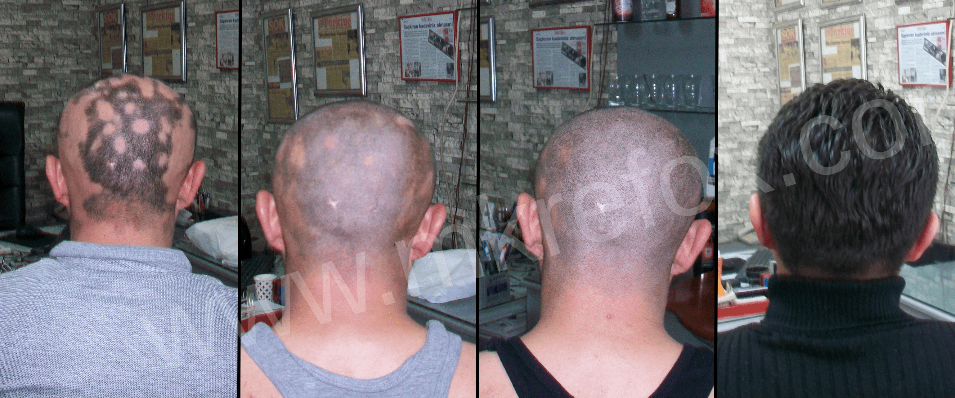 Alopesi Tedavisinde Etkin Çözümler