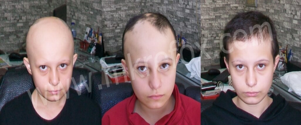 Alopesi Areata Konya Kliniği