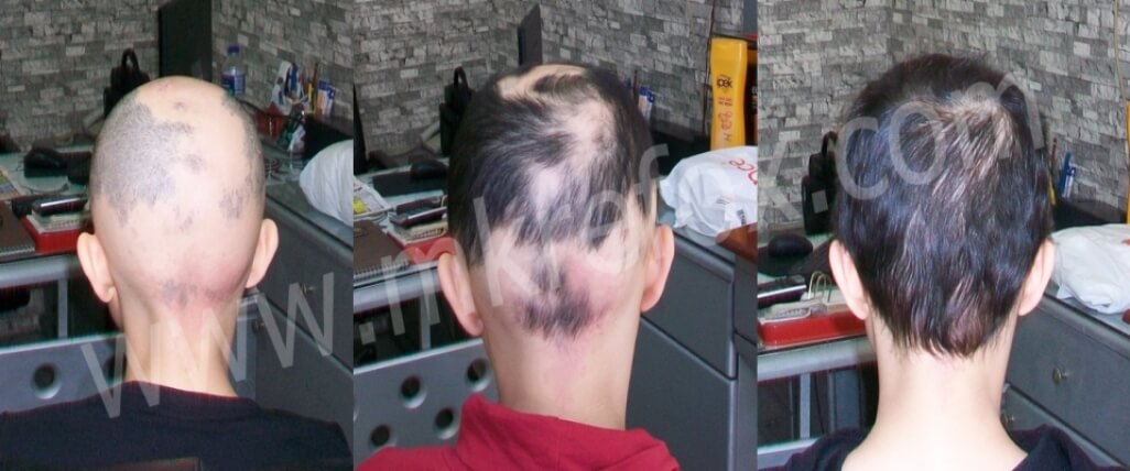 Alopesi Tedavisinde Başarı Hikayeleri