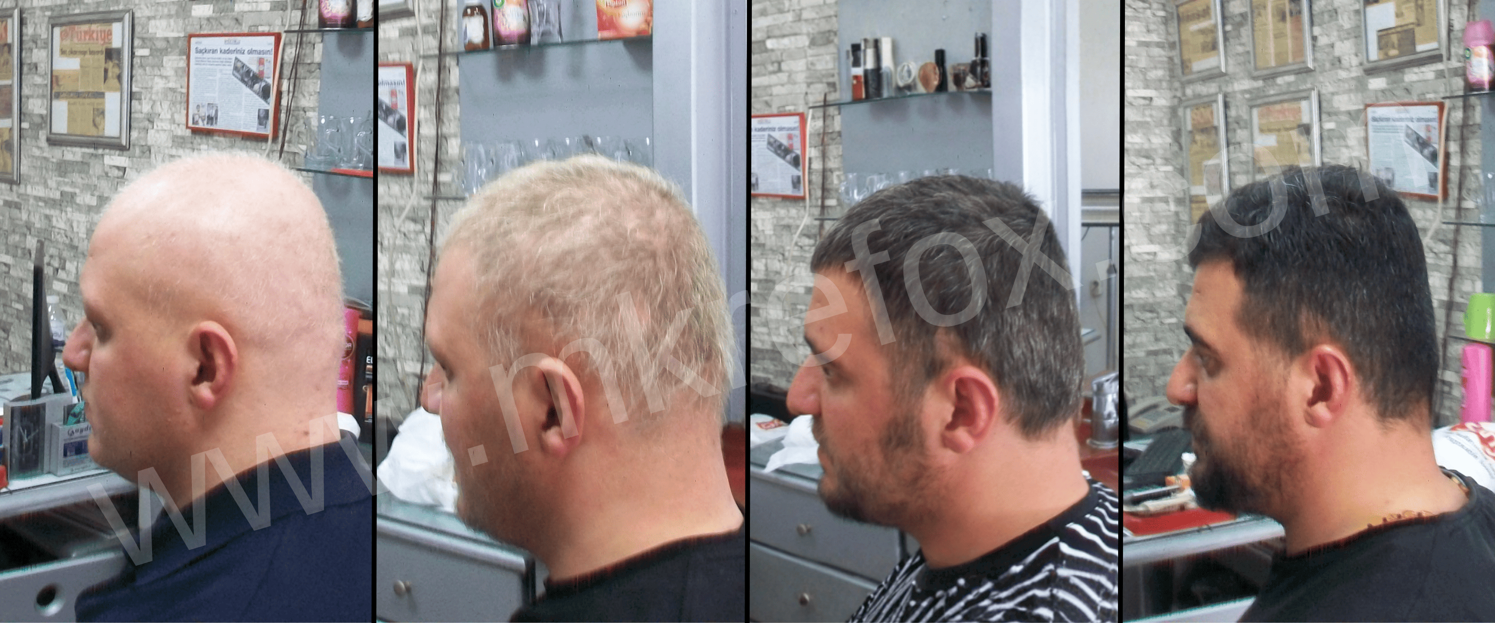 Konya Alopesi Areata Tedavi Sonuçları